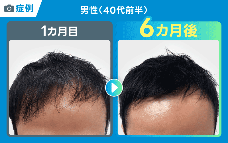 DMM AGA 症例写真
