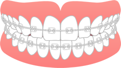ワイヤー矯正(全体矯正)